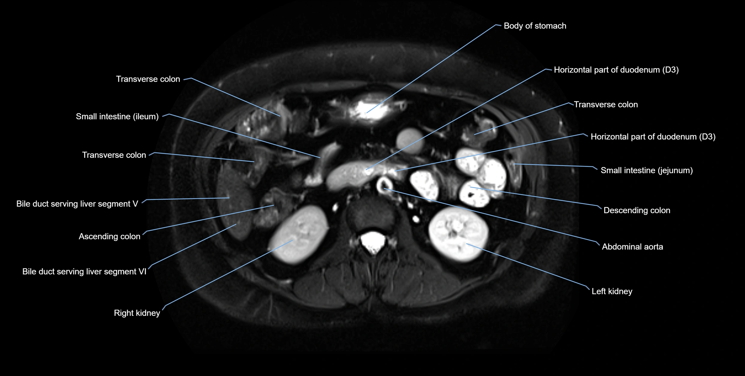 MRI MRCP axial cross sectional anatomy 3T radiology  image-img-10001-00031.webp